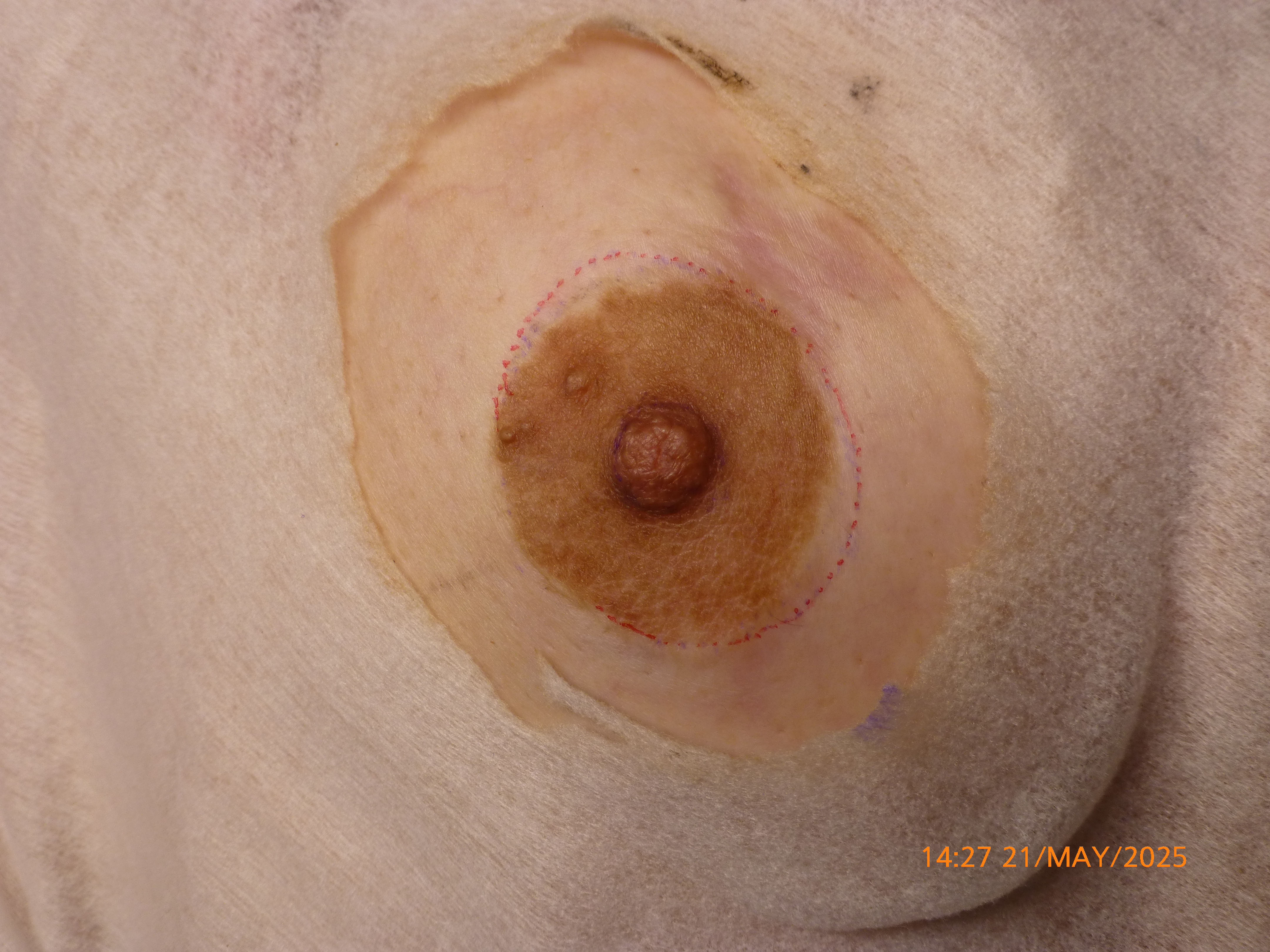 3D AREOLA